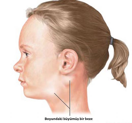 Çocuğun Boğazında Şişlik Belirtileri ve Tedavisi