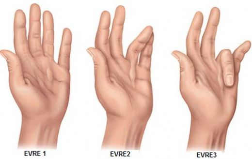 Parmak Eklemlerinde Şişlik Belirtileri ve Tedavisi